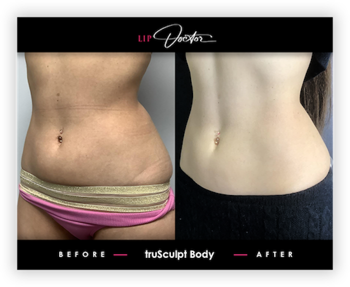 truSculpt® iD Before After Results 1
